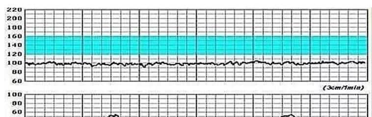 胎心监护检查什么 - 正常值范围 - 监测图看法
