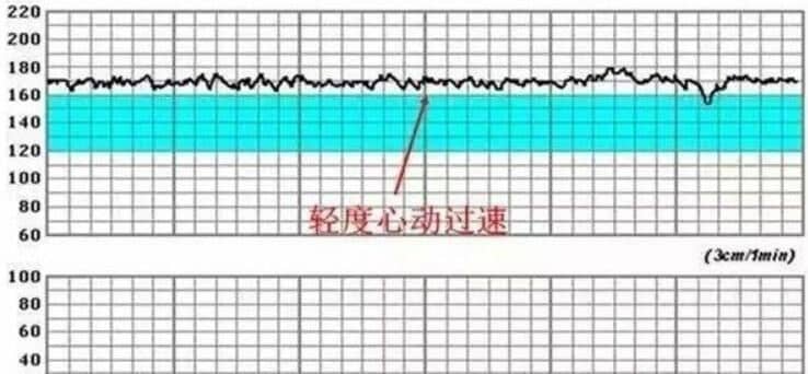 胎心监护检查什么 - 正常值范围 - 监测图看法