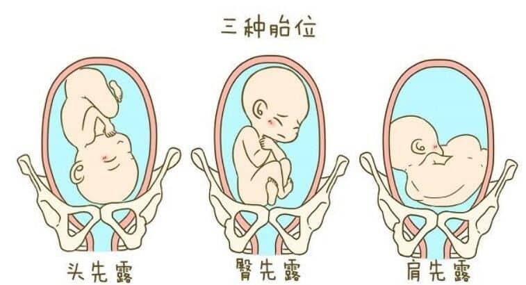 胎儿臀位是什么意思 - 造成原因 - 纠正方法