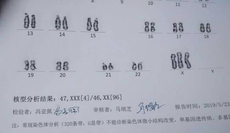 羊水穿刺检查风险