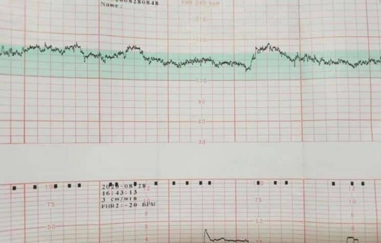 胎心监护检查什么 - 正常值范围 - 监测图看法