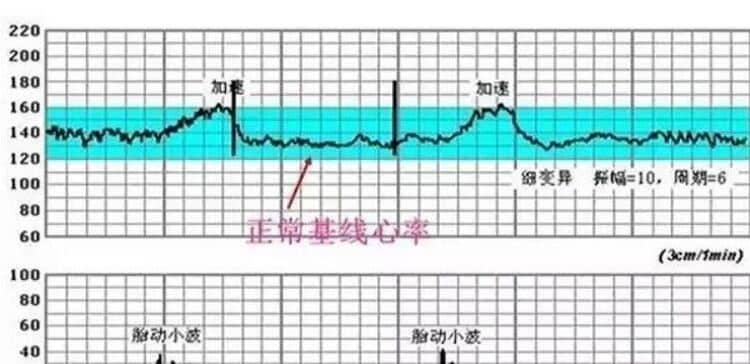 胎心监护检查什么 - 正常值范围 - 监测图看法